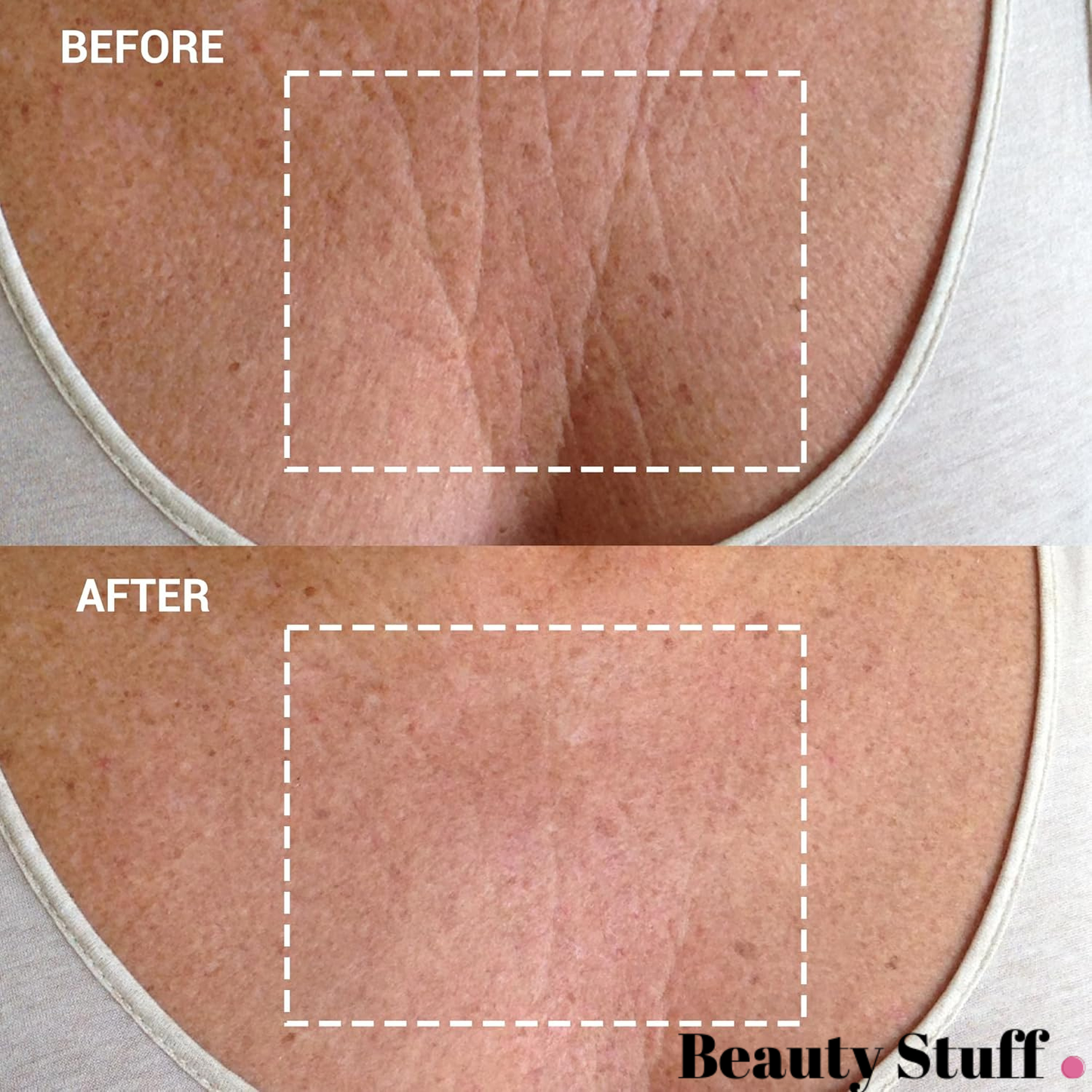 Dekolte Bölgesi Kırışıklık Gidermeye Yardımcı Ped - 100 % Medikal Silikon - Chest Wrinkle Patch