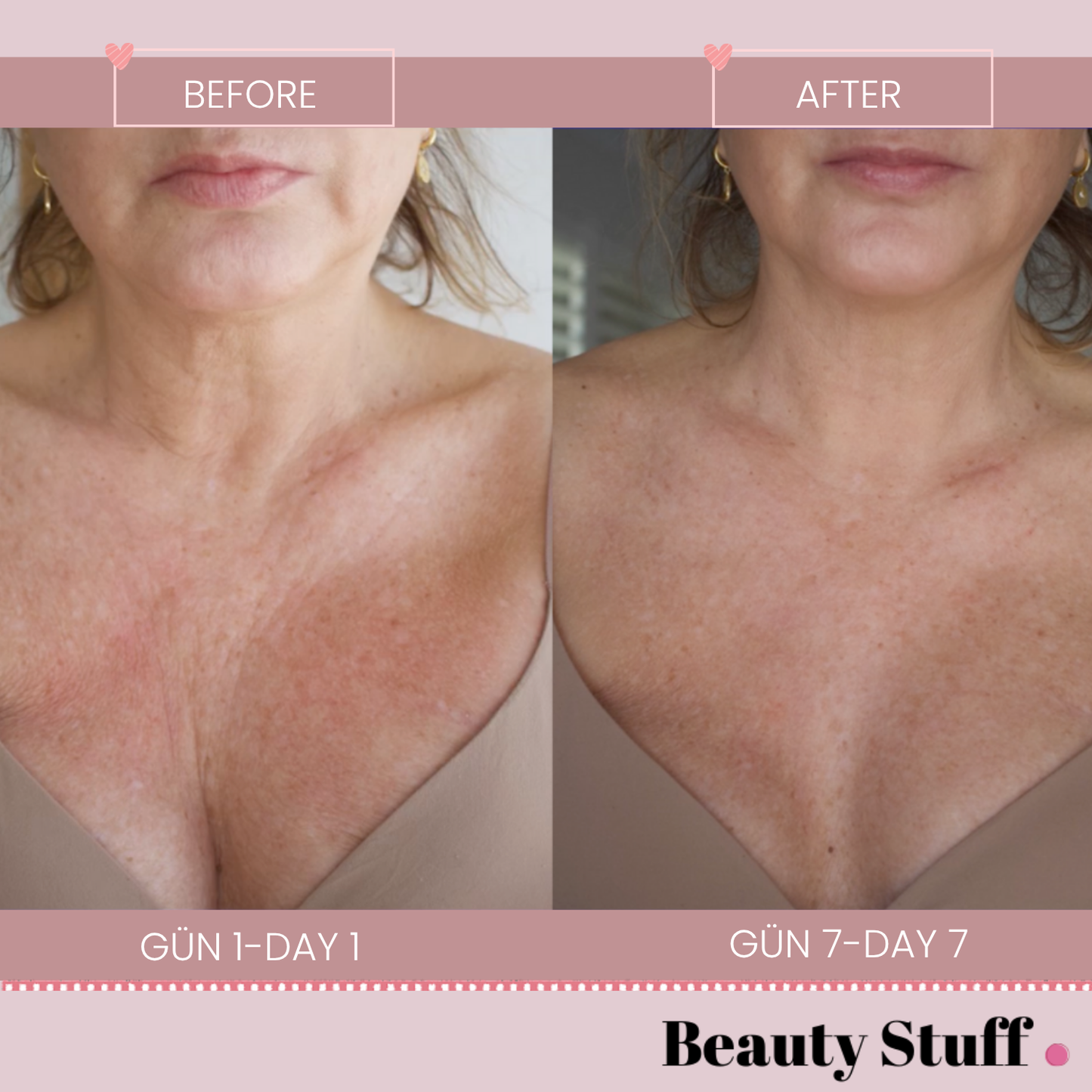 Dekolte Bölgesi Kırışıklık Gidermeye Yardımcı Ped - 100 % Medikal Silikon - Chest Wrinkle Patch